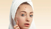 Acne scar treatment in islamabad Pakistan