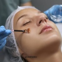 Chemical Peels in Dubai
