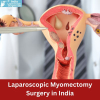 Laparoscopic Myomectomy Surgery in India