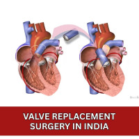 Valve Replacement Surgery Cost in India