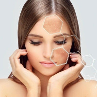 Melasma treatment in islamabad Pakistan